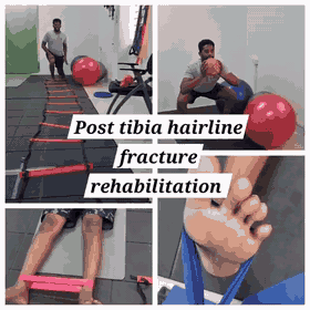 Post tibia hairline fracture sports rehabilitation exercises